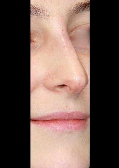 Non-Surgical Rhinoplasty Before & After Gallery - Patient 143521942 - Image 2