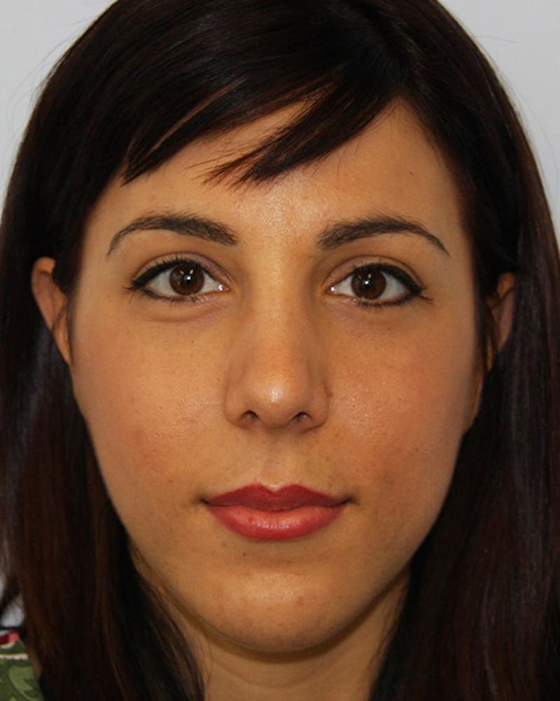 Rhinoplasty Before & After Gallery - Patient 143521950 - Image 2