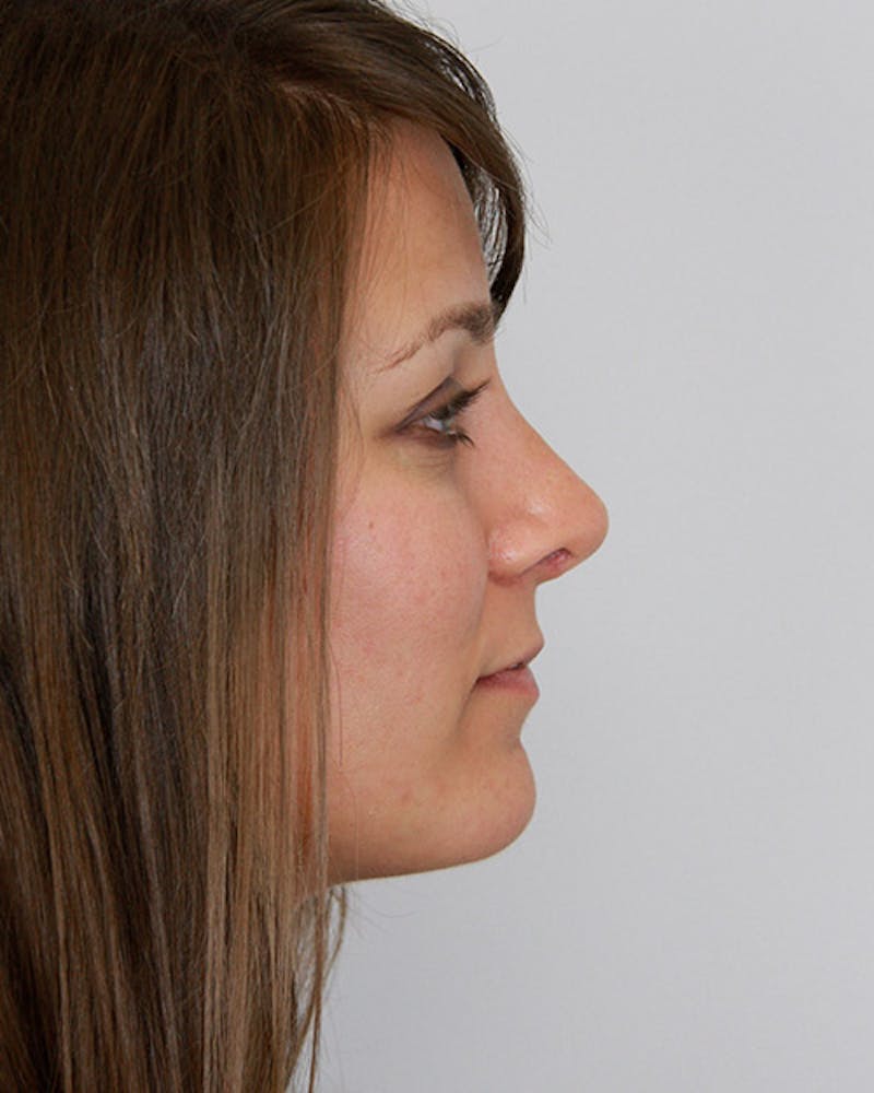 Revision Rhinoplasty Before & After Gallery - Patient 143521951 - Image 6