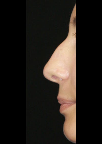 Non-Surgical Rhinoplasty Before & After Gallery - Patient 143521948 - Image 1