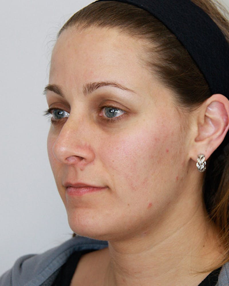Revision Rhinoplasty Before & After Gallery - Patient 143521951 - Image 7