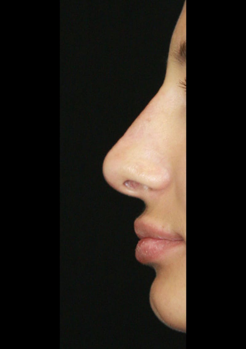 Non-Surgical Rhinoplasty Before & After Gallery - Patient 143521948 - Image 2
