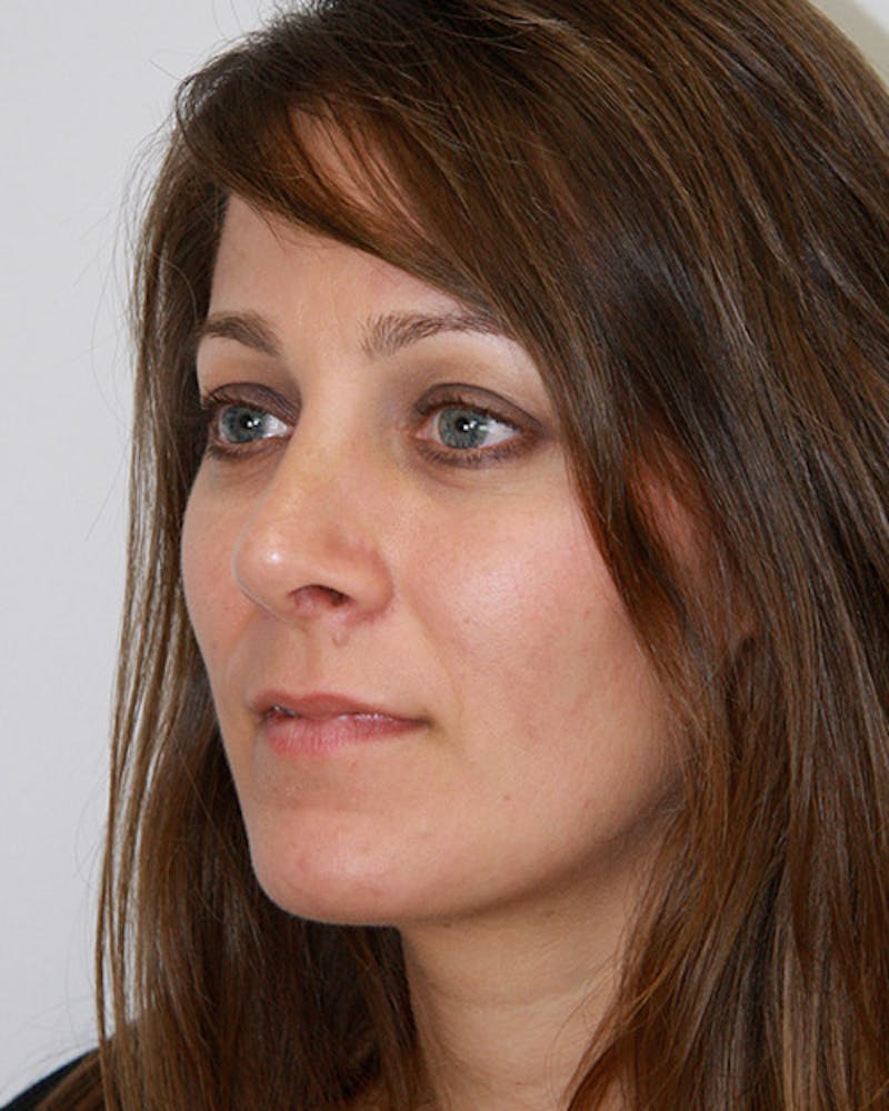 Revision Rhinoplasty Before & After Gallery - Patient 143521951 - Image 8