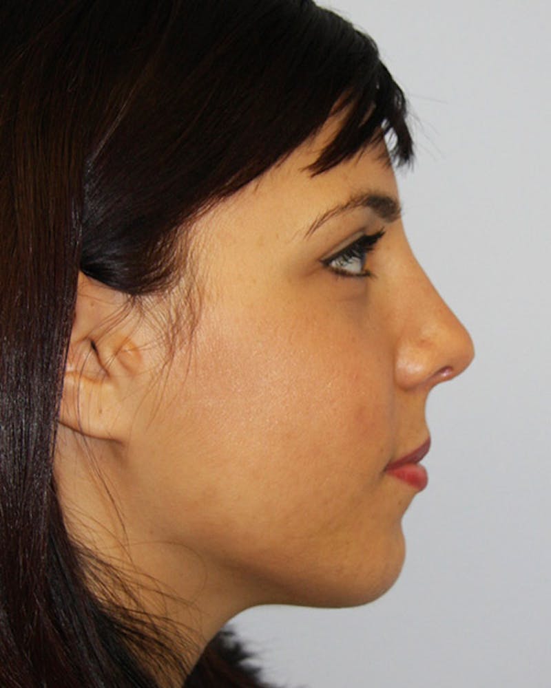 Rhinoplasty Before & After Gallery - Patient 143521950 - Image 4