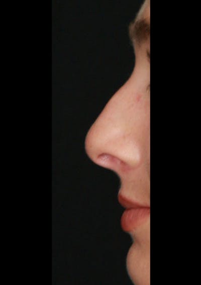 Non-Surgical Rhinoplasty Before & After Gallery - Patient 143521949 - Image 1