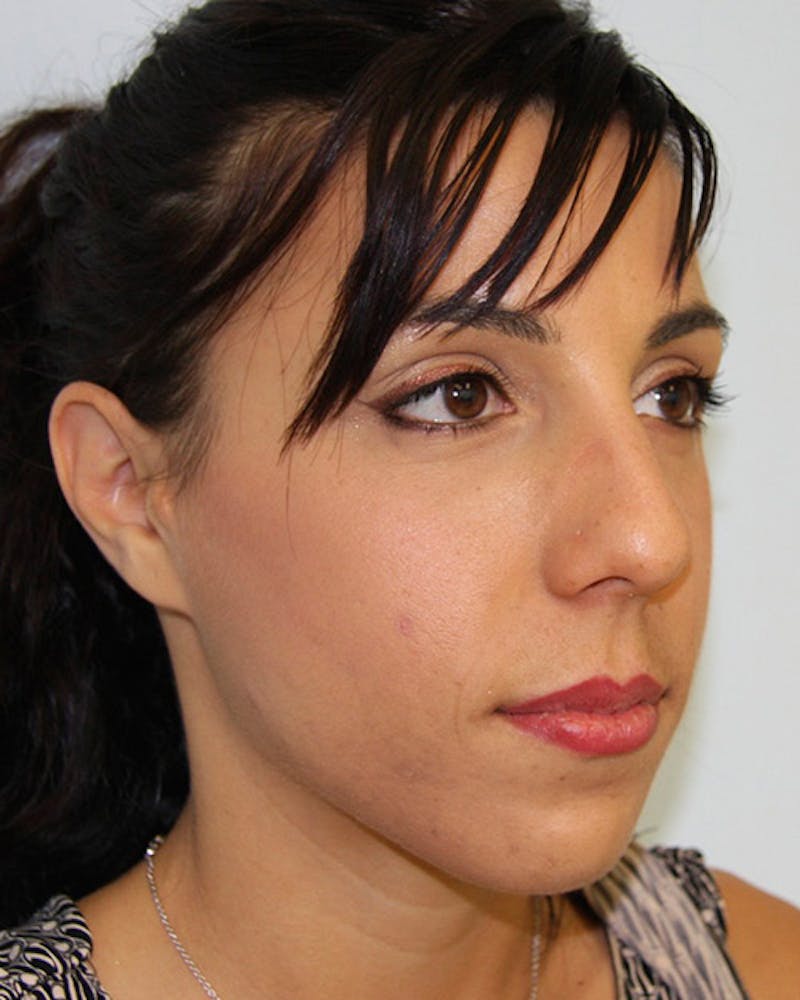 Rhinoplasty Before & After Gallery - Patient 143521950 - Image 5