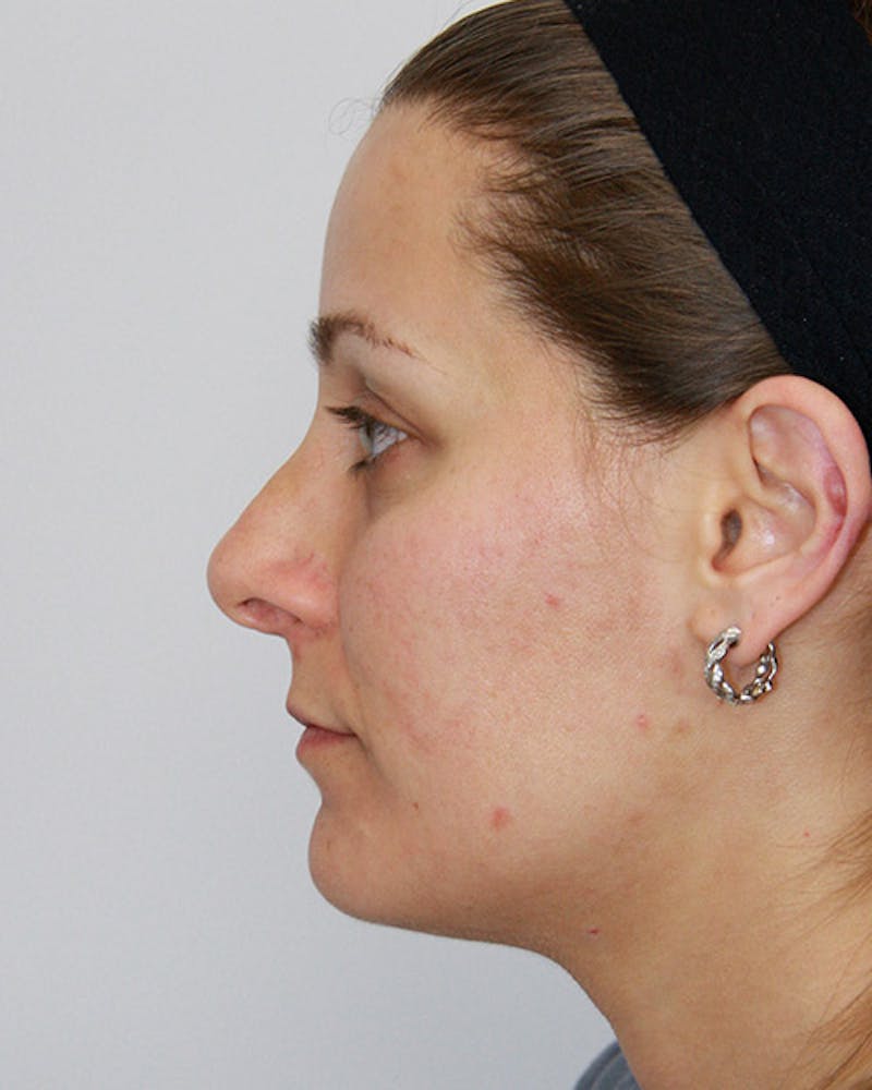 Revision Rhinoplasty Before & After Gallery - Patient 143521951 - Image 9