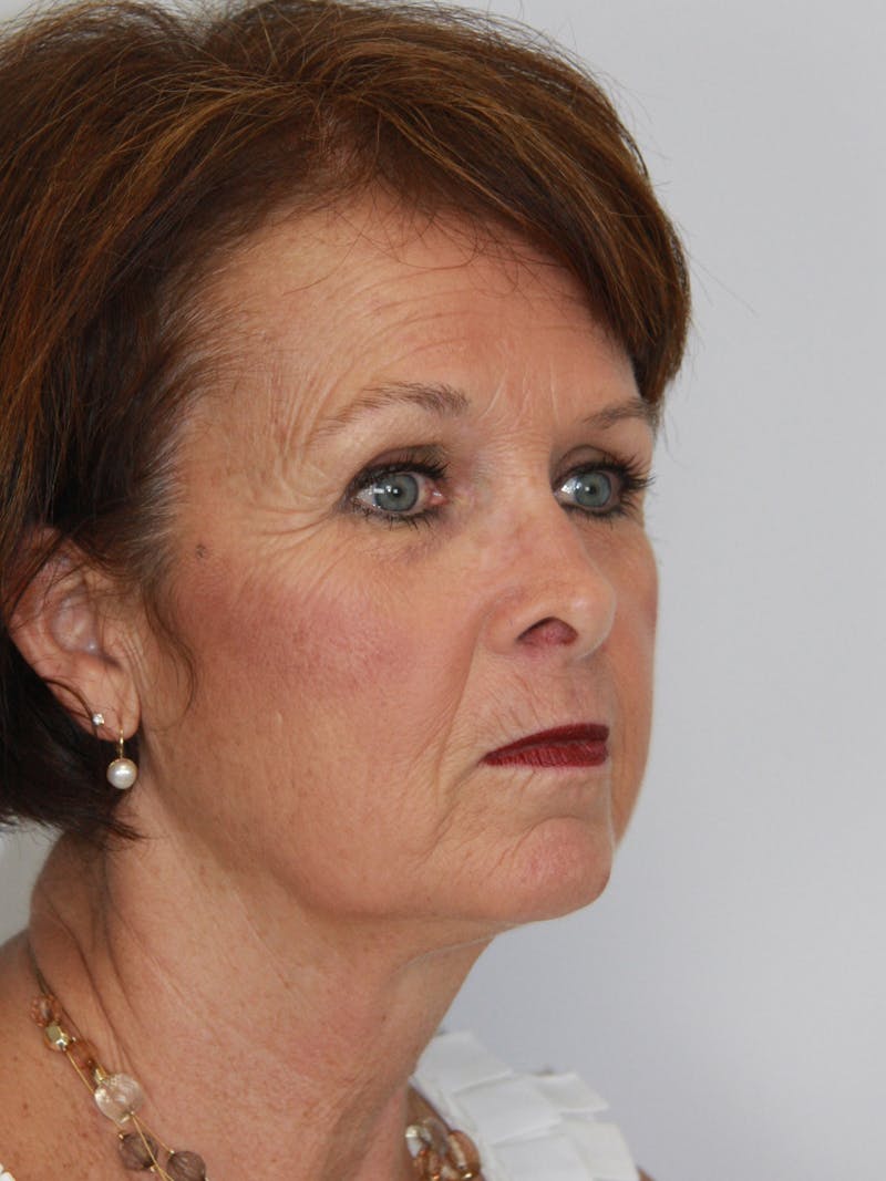 Eyelid Surgery Before & After Gallery - Patient 143521959 - Image 3