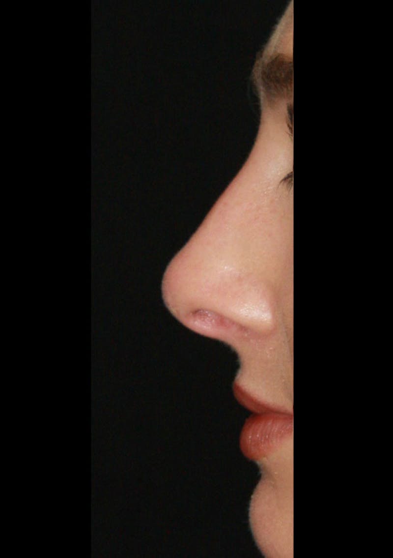 Non-Surgical Rhinoplasty Before & After Gallery - Patient 143521949 - Image 2