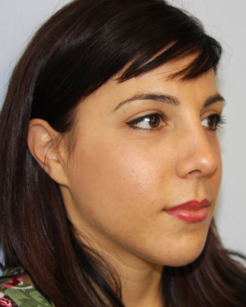 Rhinoplasty Before & After Gallery - Patient 143521950 - Image 6