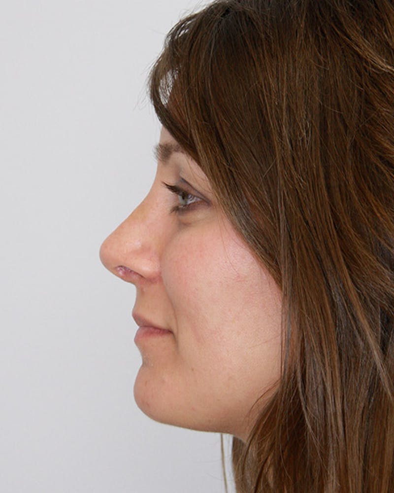 Revision Rhinoplasty Before & After Gallery - Patient 143521951 - Image 10