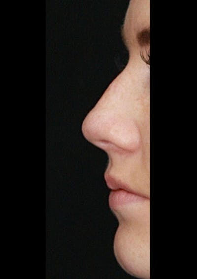 Non-Surgical Rhinoplasty Before & After Gallery - Patient 143521952 - Image 1