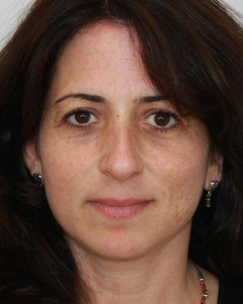 Rhinoplasty Before & After Gallery - Patient 143521956 - Image 1