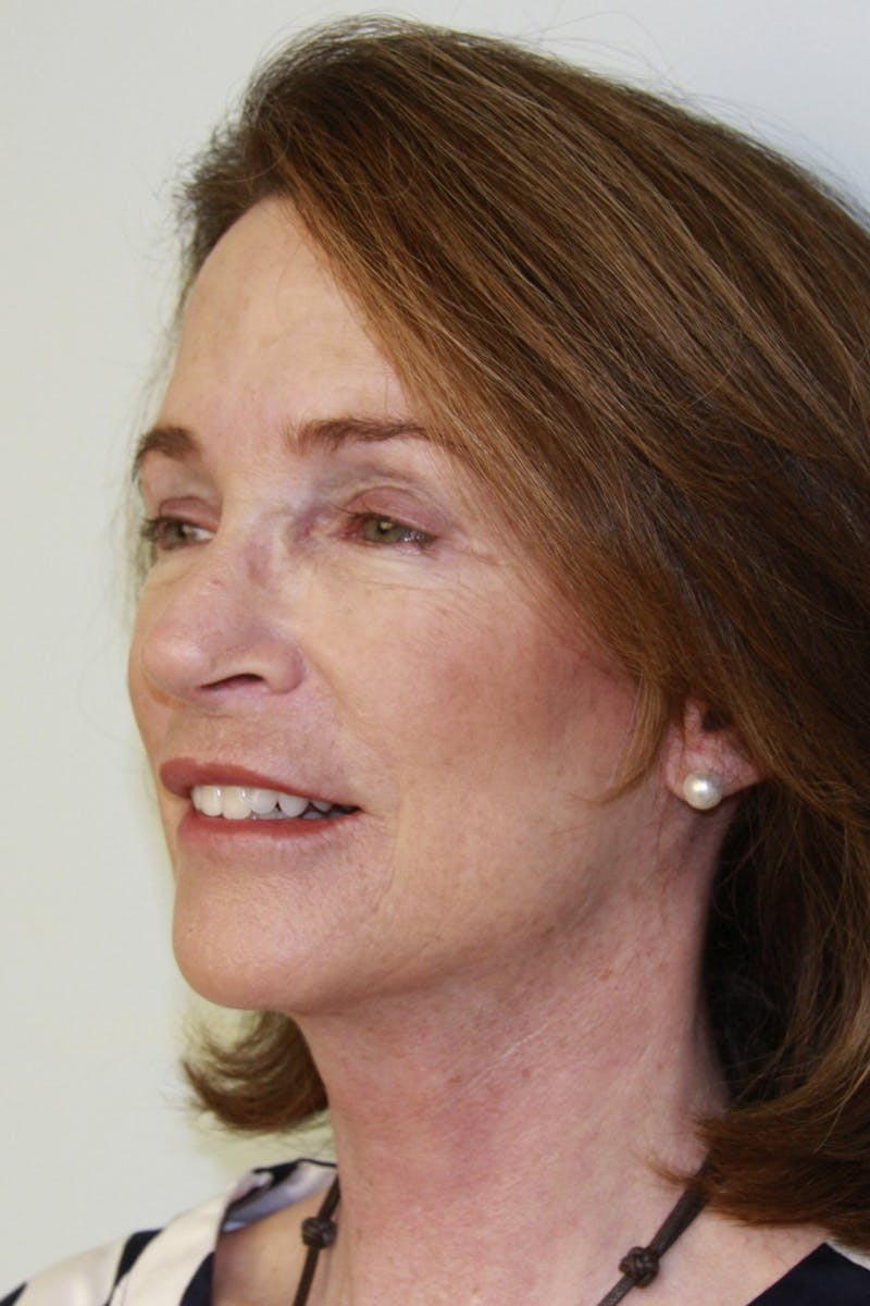 Facelift & Neck Lift Before & After Gallery - Patient 143521955 - Image 8