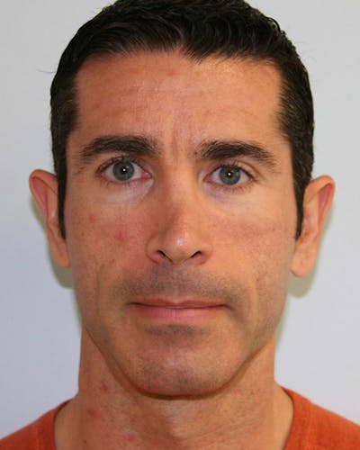 Revision Rhinoplasty Before & After Gallery - Patient 143521954 - Image 1
