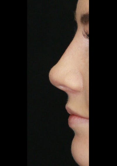 Non-Surgical Rhinoplasty Before & After Gallery - Patient 143521952 - Image 2