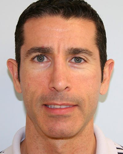 Revision Rhinoplasty Before & After Gallery - Patient 143521954 - Image 2