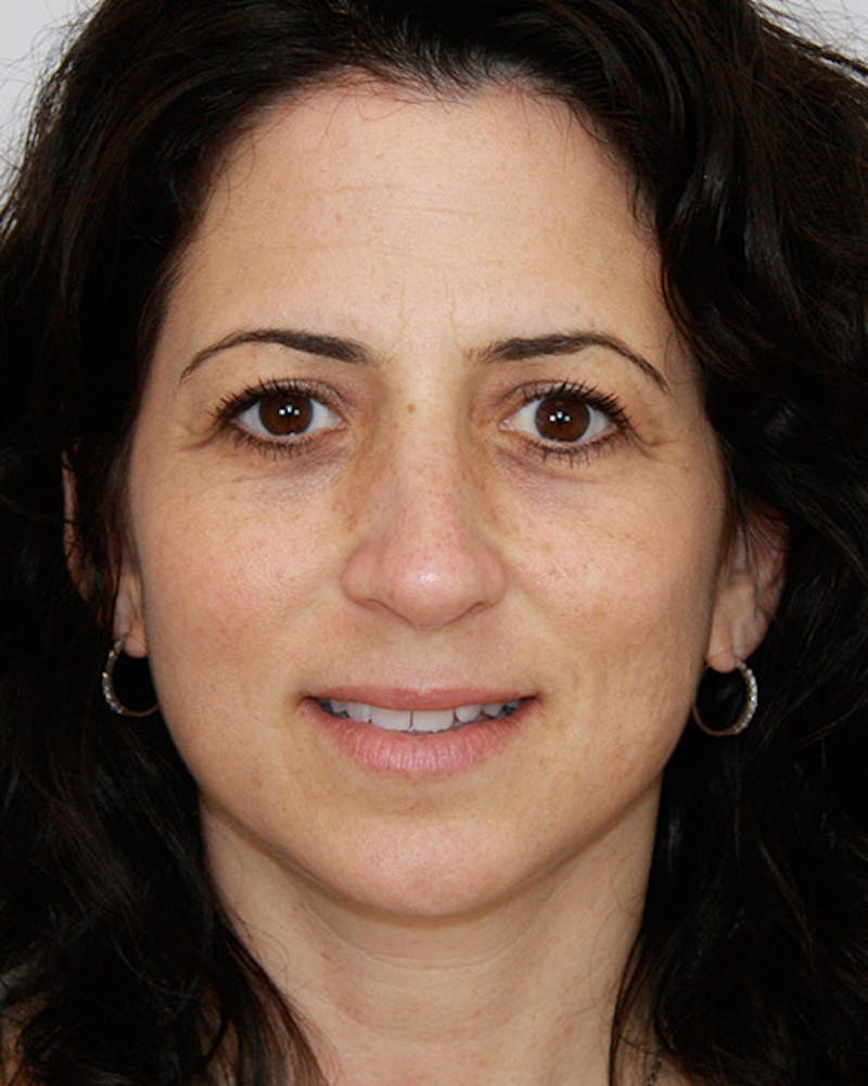 Rhinoplasty Before & After Gallery - Patient 143521956 - Image 2