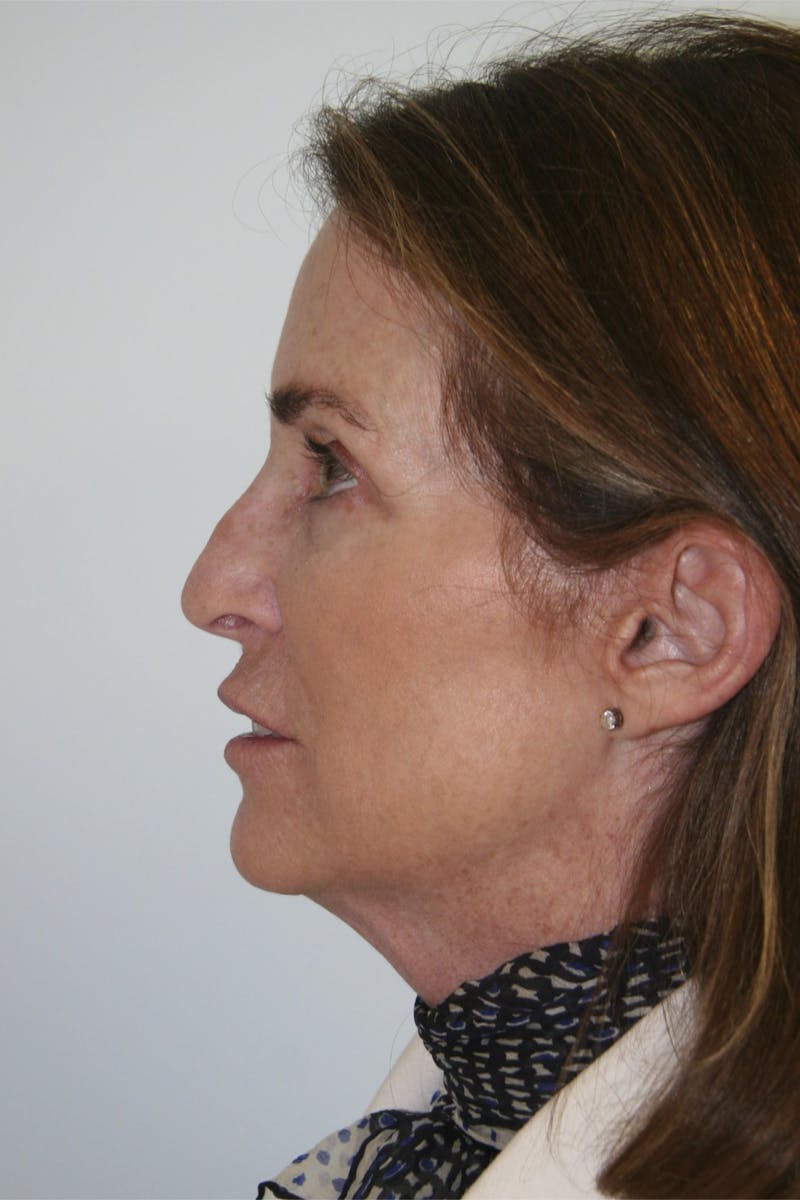 Facelift & Neck Lift Before & After Gallery - Patient 143521955 - Image 9