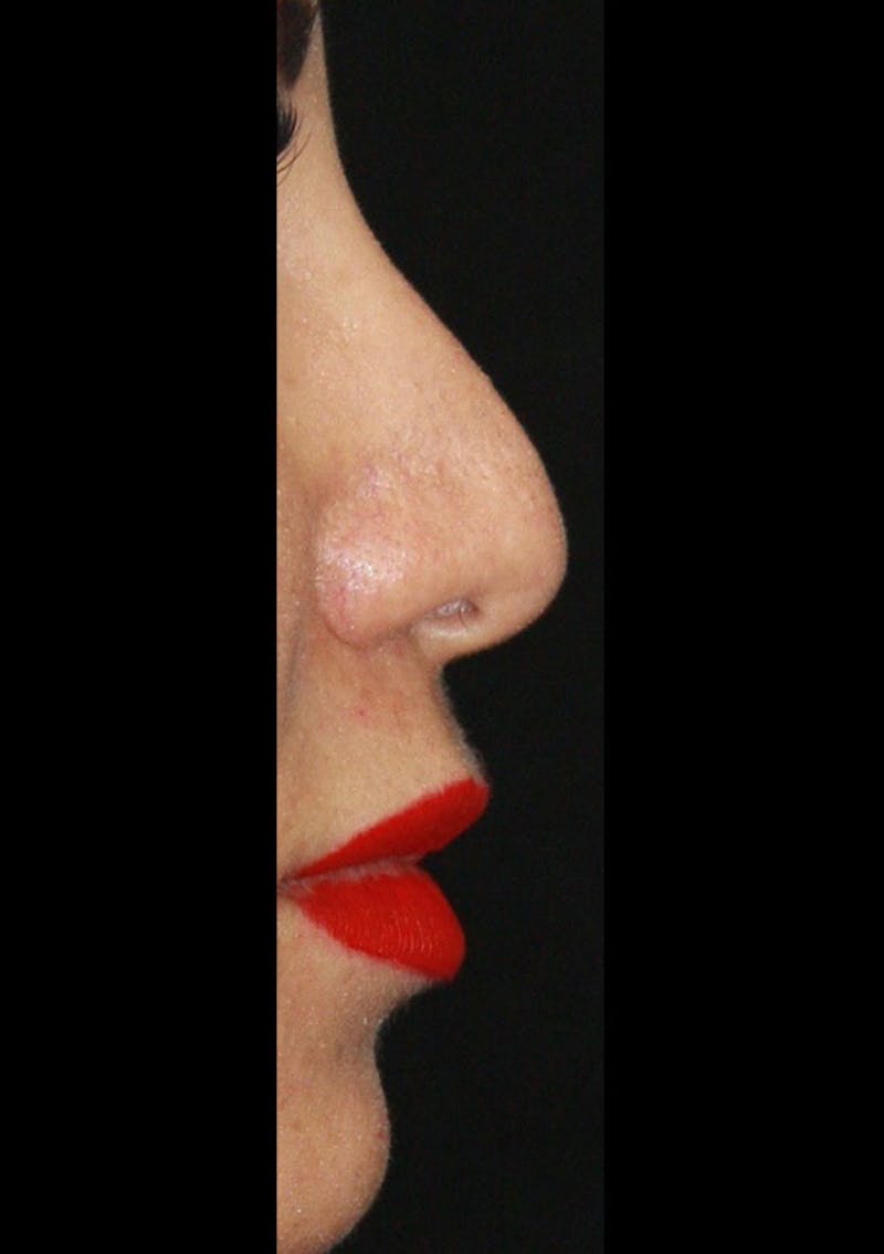 Non-Surgical Rhinoplasty Before & After Gallery - Patient 143521953 - Image 1