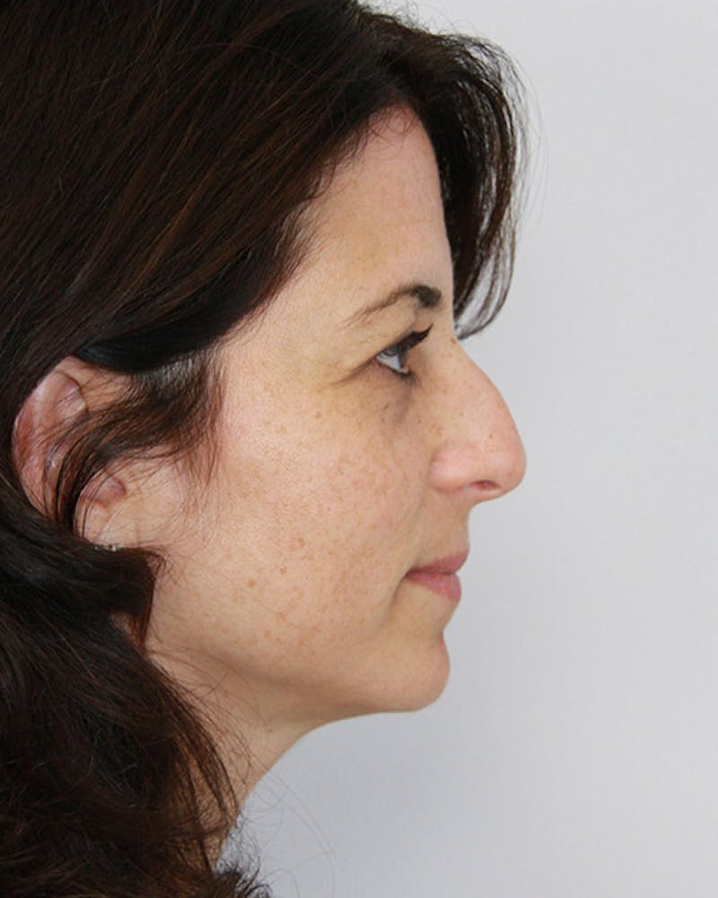Rhinoplasty Before & After Gallery - Patient 143521956 - Image 3
