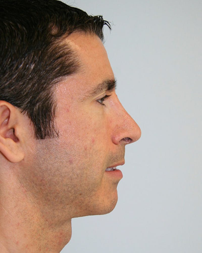 Revision Rhinoplasty Before & After Gallery - Patient 143521954 - Image 3
