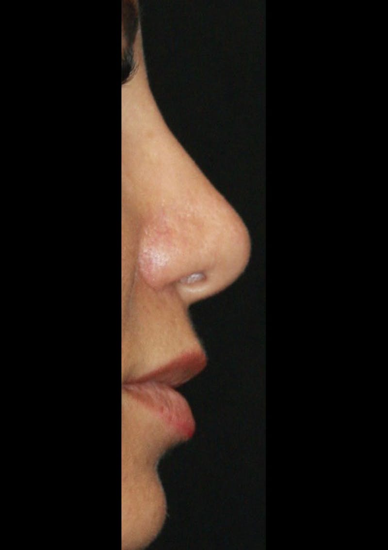 Non-Surgical Rhinoplasty Before & After Gallery - Patient 143521953 - Image 2
