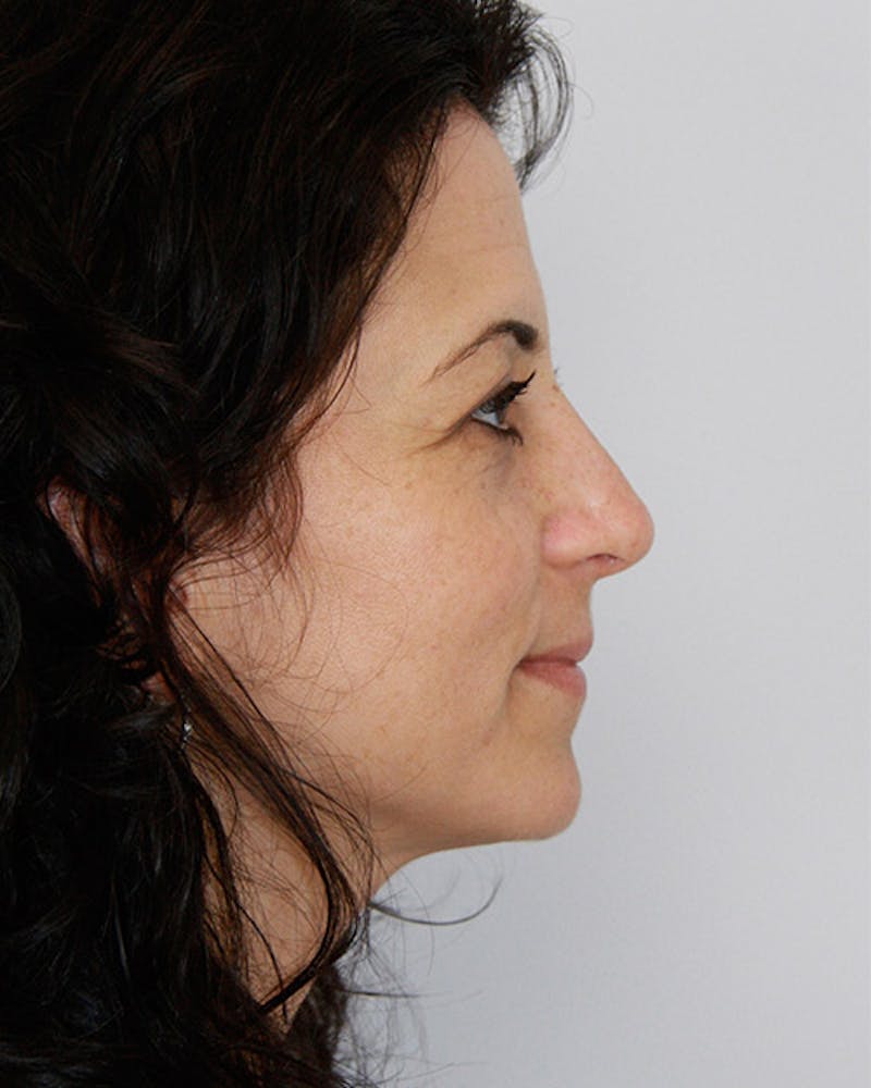 Rhinoplasty Before & After Gallery - Patient 143521956 - Image 4