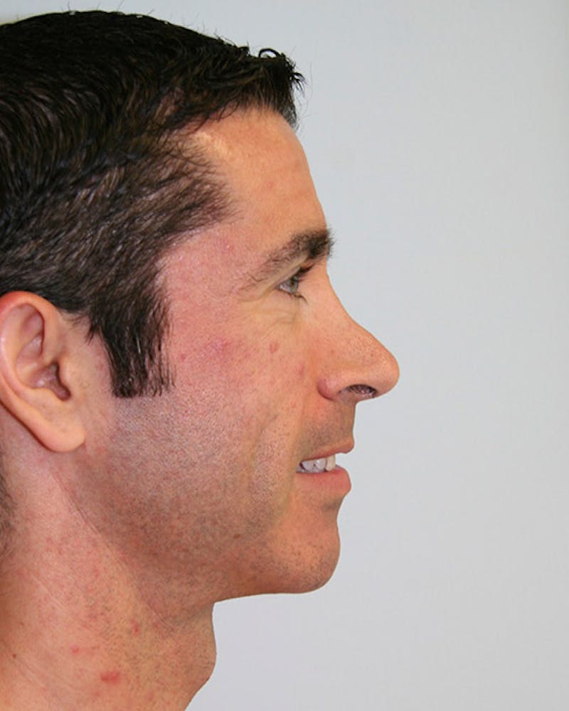 Revision Rhinoplasty Before & After Gallery - Patient 143521954 - Image 4