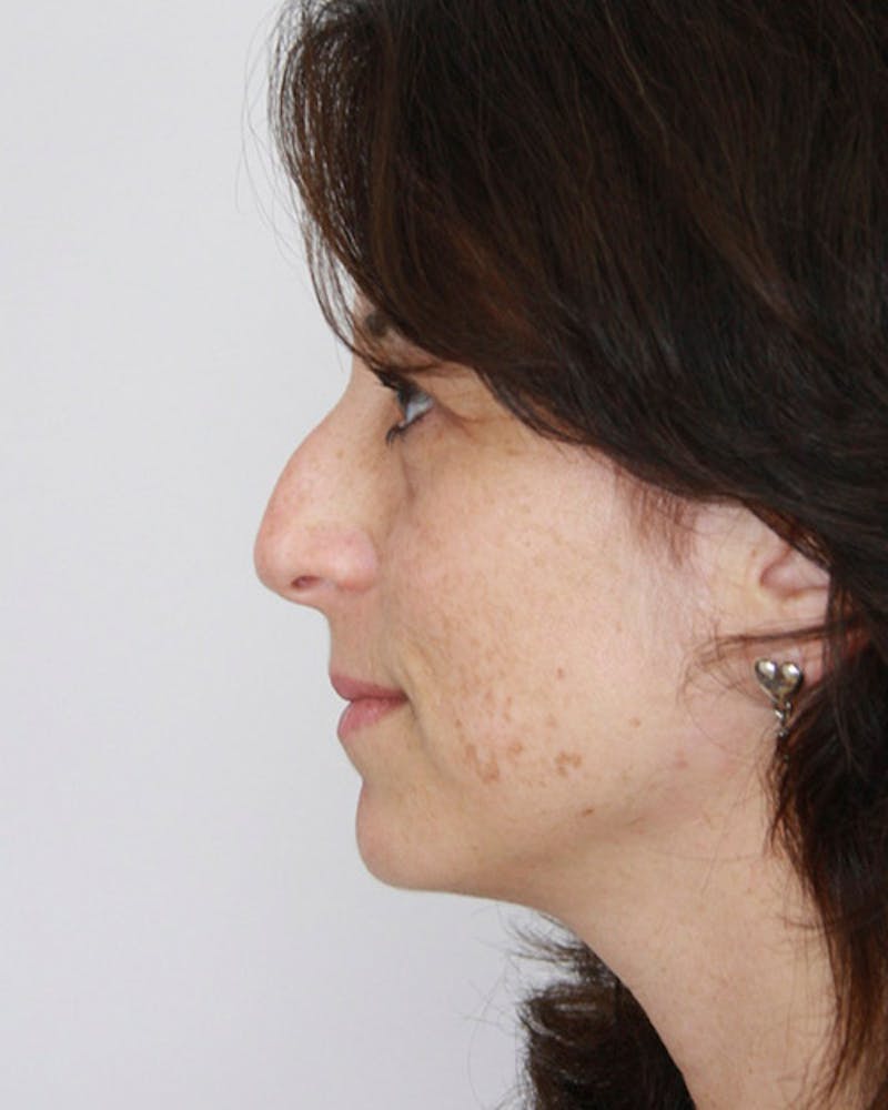 Rhinoplasty Before & After Gallery - Patient 143521956 - Image 5
