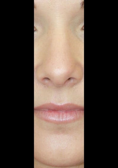 Non-Surgical Rhinoplasty Before & After Gallery - Patient 143521957 - Image 1