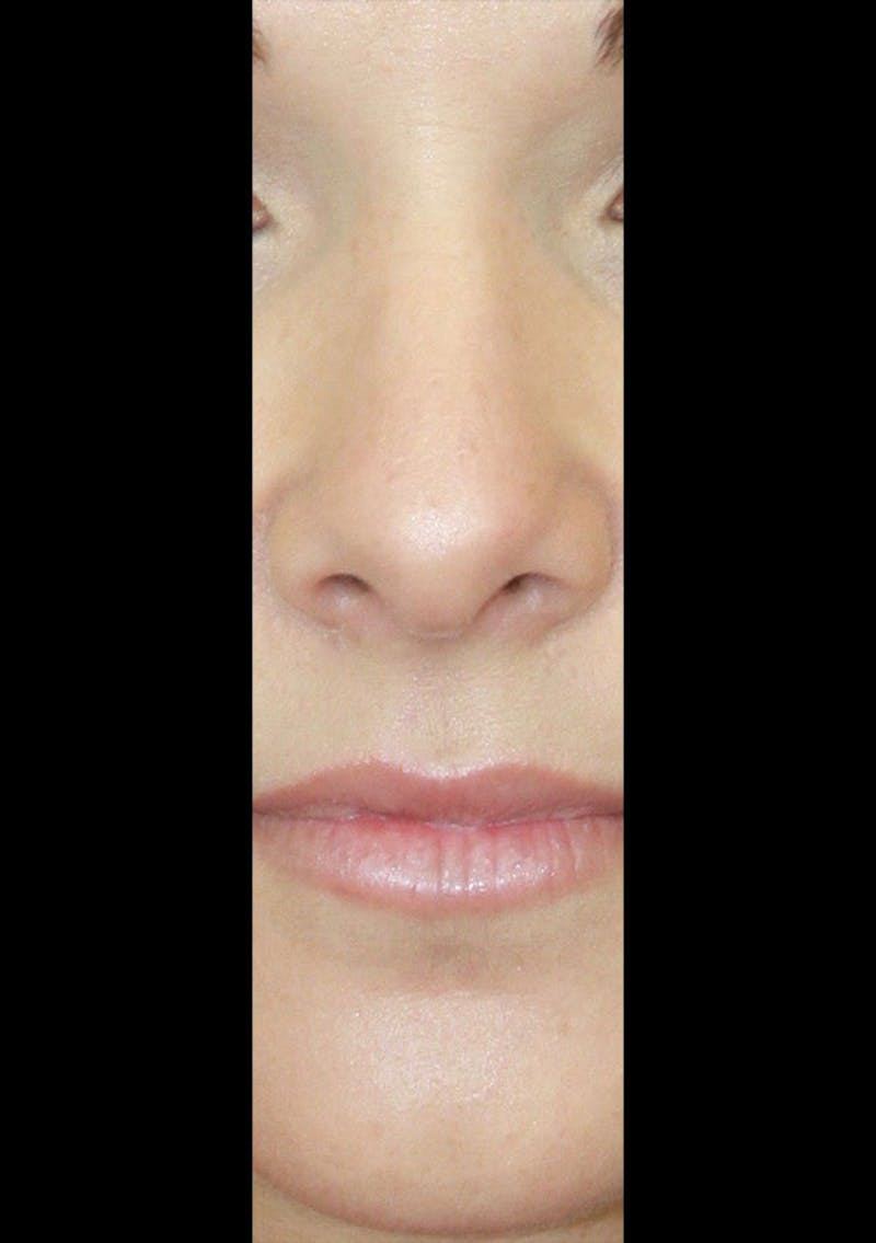 Non-Surgical Rhinoplasty Before & After Gallery - Patient 143521957 - Image 1