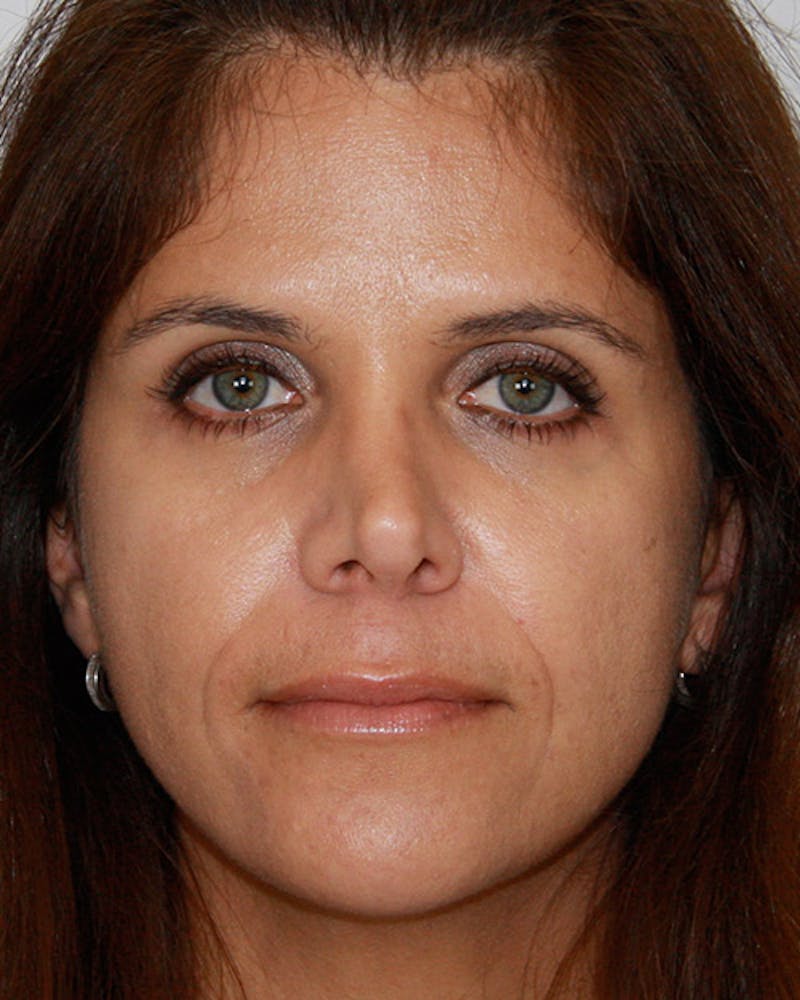 Revision Rhinoplasty Before & After Gallery - Patient 143521960 - Image 1