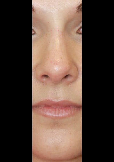 Non-Surgical Rhinoplasty Before & After Gallery - Patient 143521957 - Image 2