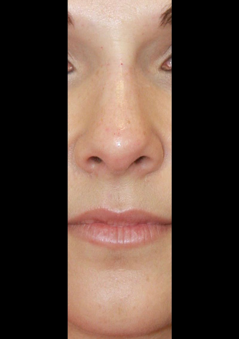 Non-Surgical Rhinoplasty Before & After Gallery - Patient 143521957 - Image 2