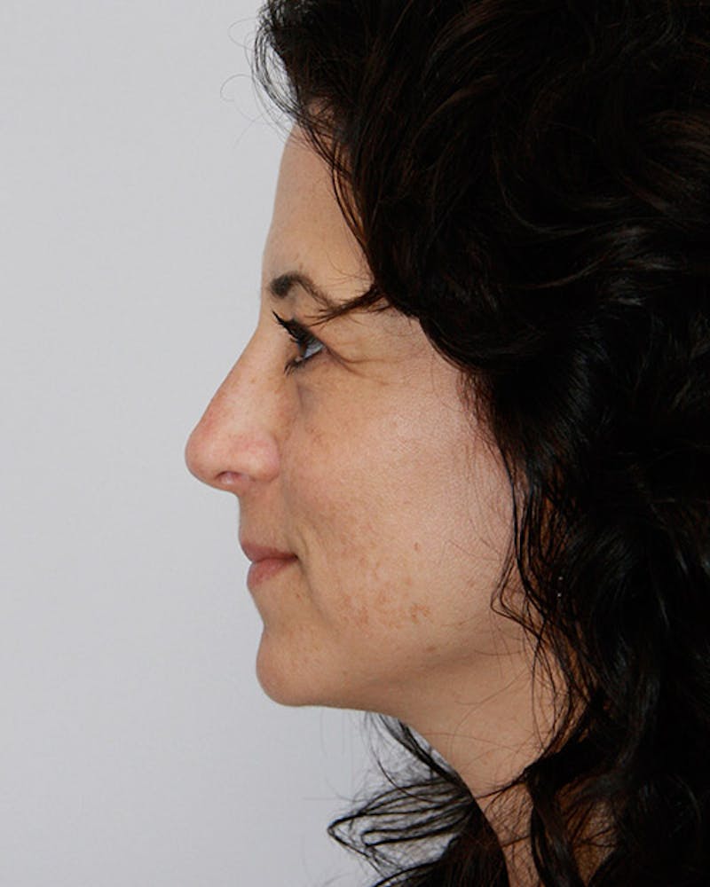 Rhinoplasty Before & After Gallery - Patient 143521956 - Image 6
