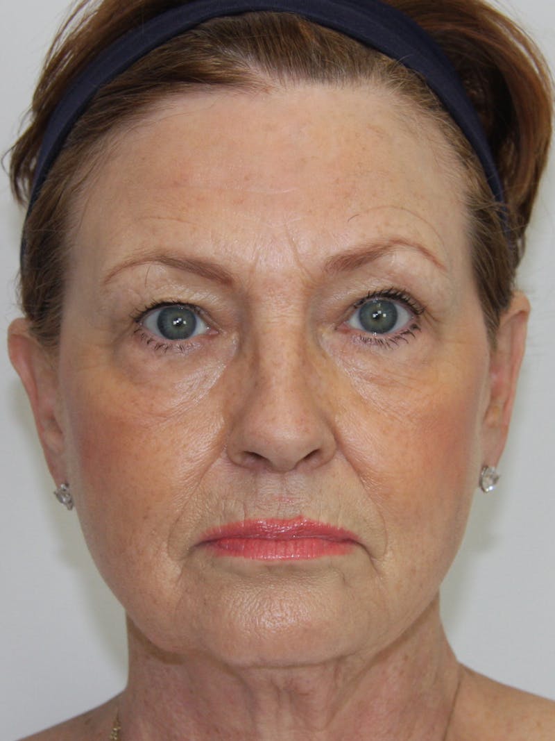 Facelift & Neck Lift Before & After Gallery - Patient 143521965 - Image 1