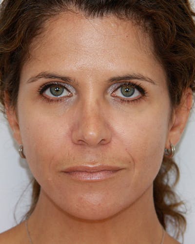 Revision Rhinoplasty Before & After Gallery - Patient 143521960 - Image 2