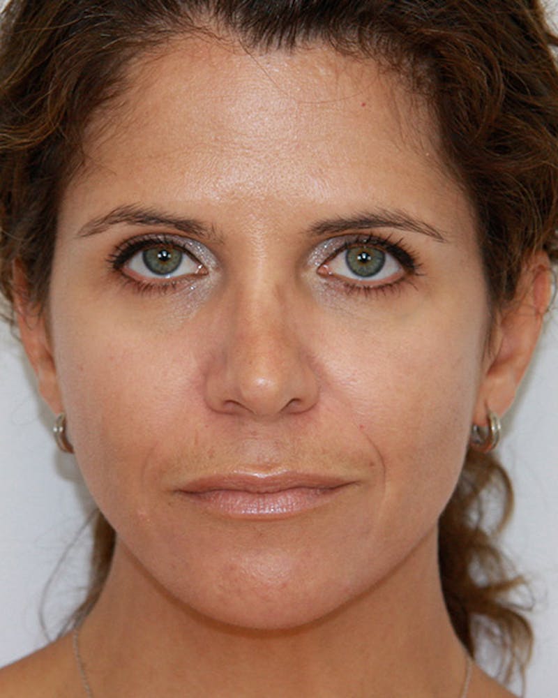 Revision Rhinoplasty Before & After Gallery - Patient 143521960 - Image 2
