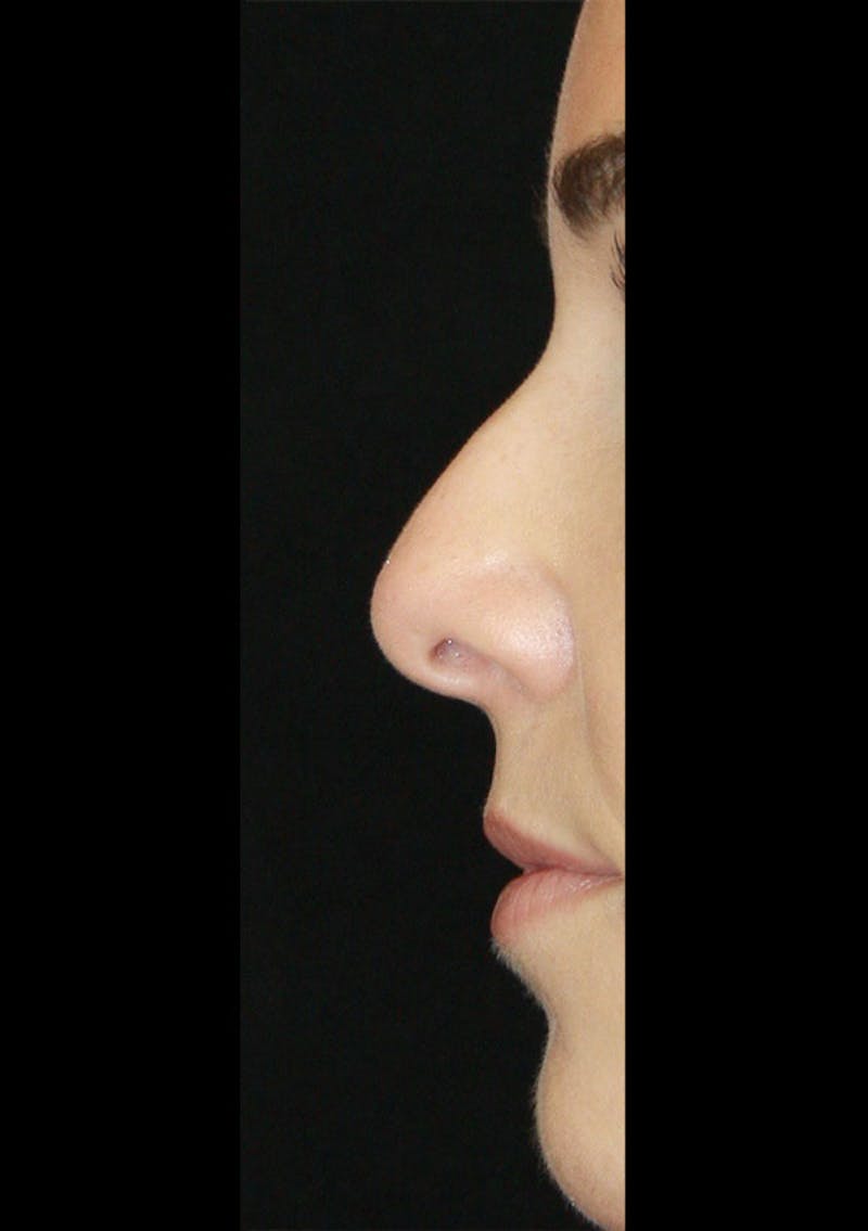 Non-Surgical Rhinoplasty Before & After Gallery - Patient 143521957 - Image 3