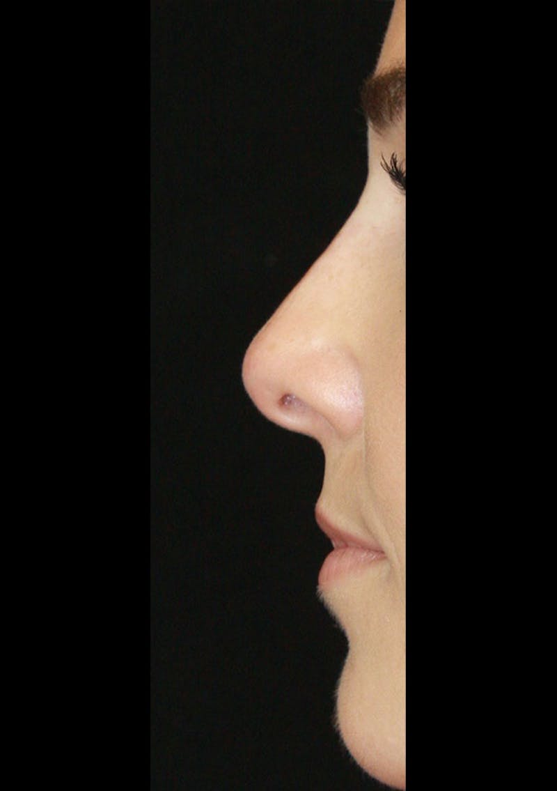 Non-Surgical Rhinoplasty Before & After Gallery - Patient 143521957 - Image 4