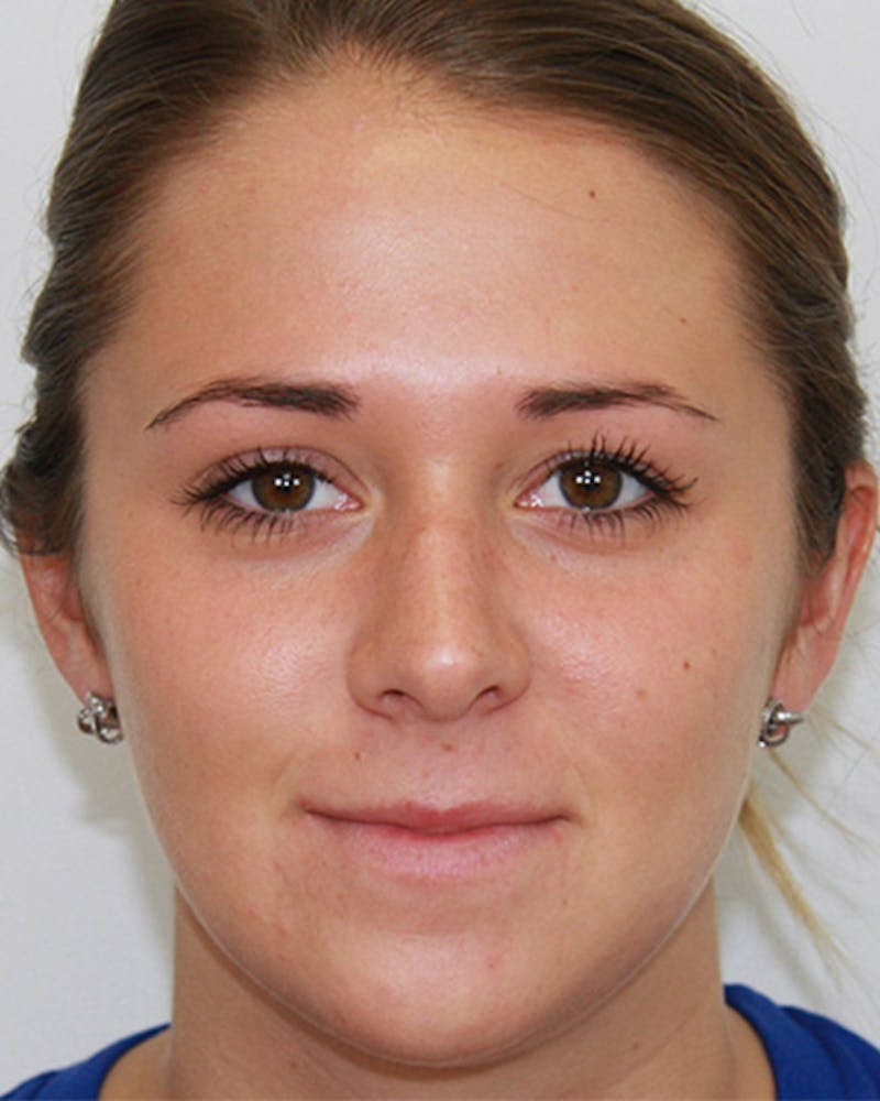 Rhinoplasty Before & After Gallery - Patient 143521961 - Image 1