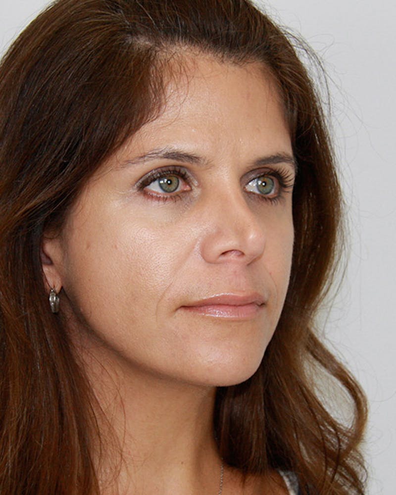 Revision Rhinoplasty Before & After Gallery - Patient 143521960 - Image 3