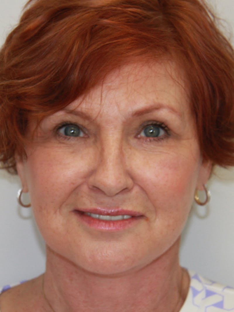 Facelift & Neck Lift Before & After Gallery - Patient 143521965 - Image 2