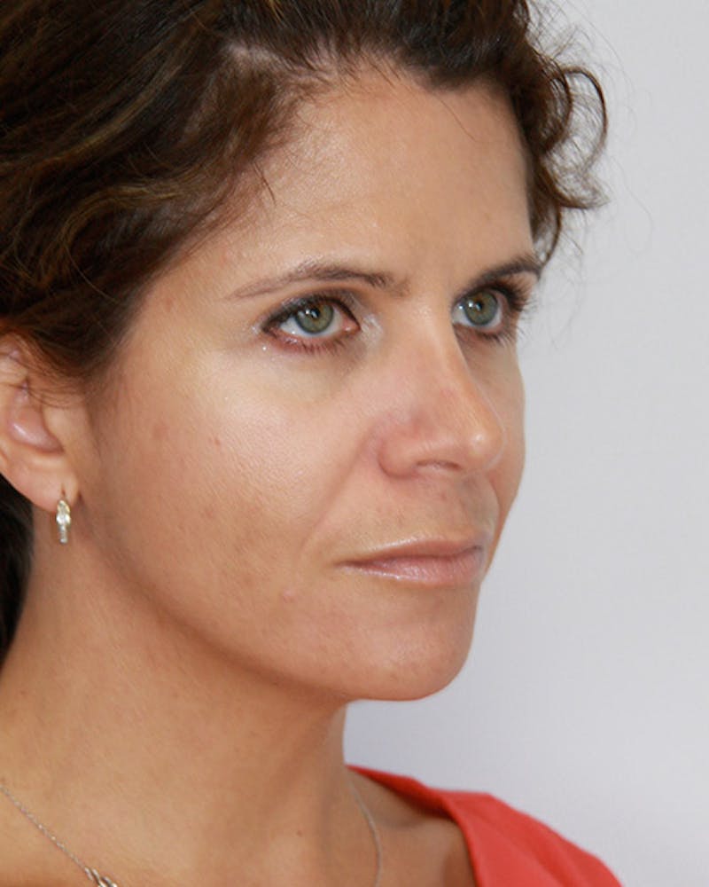 Revision Rhinoplasty Before & After Gallery - Patient 143521960 - Image 4