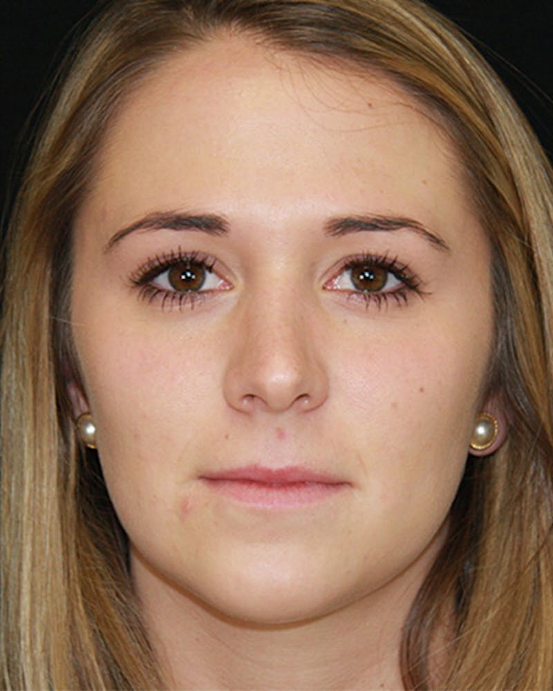 Rhinoplasty Before & After Gallery - Patient 143521961 - Image 2
