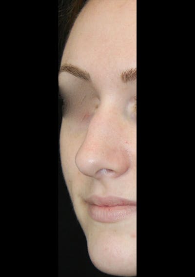 Non-Surgical Rhinoplasty Before & After Gallery - Patient 143521958 - Image 1