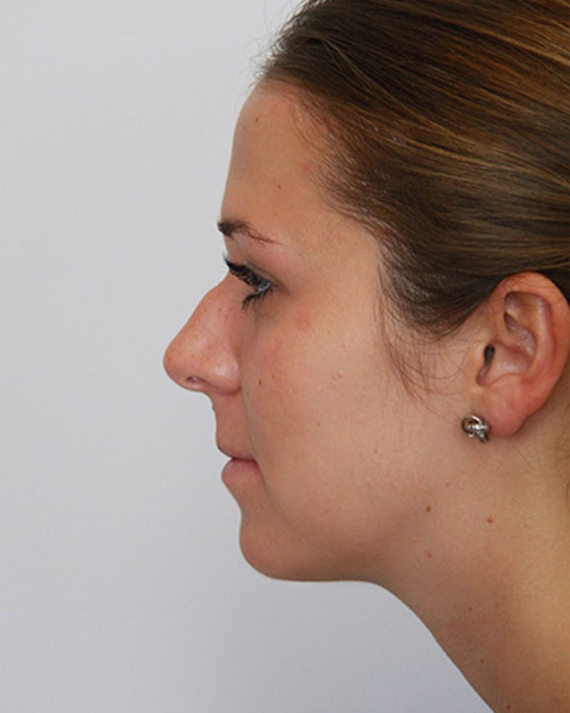 Rhinoplasty Before & After Gallery - Patient 143521961 - Image 3