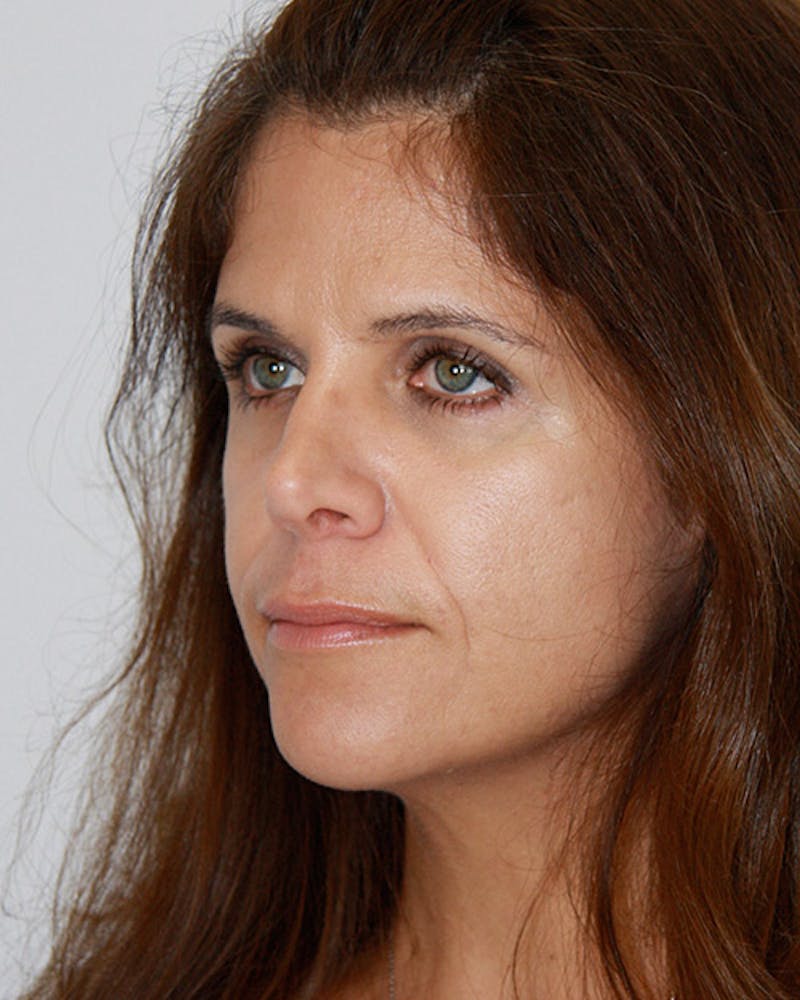 Revision Rhinoplasty Before & After Gallery - Patient 143521960 - Image 5