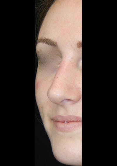 Non-Surgical Rhinoplasty Before & After Gallery - Patient 143521958 - Image 2